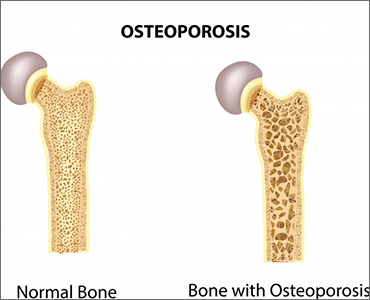 The Bone Density Solution Program